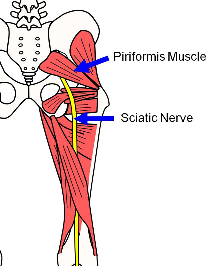 Sciatic Nerve Pain Hip Problems Download Home Remedies To Help Sciatic